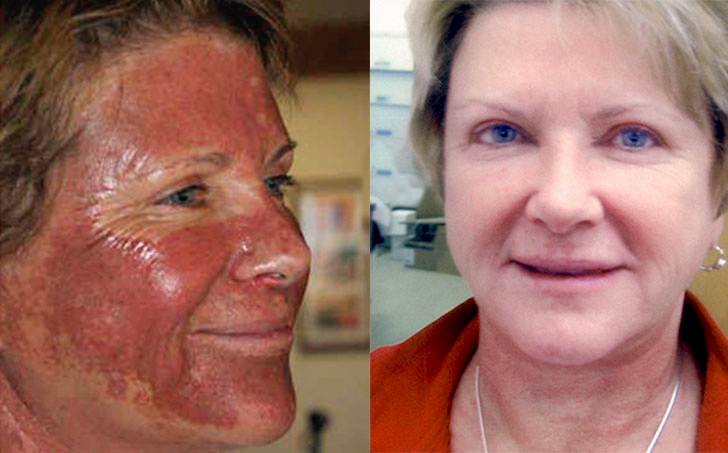 Intense Pulsed Light burn healed within a week 