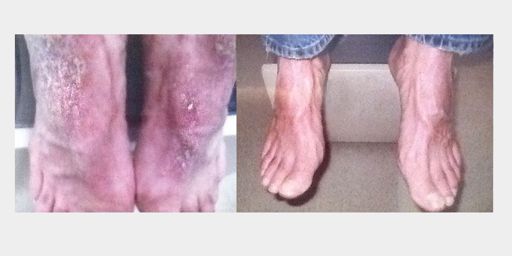 Psoriasis healed with Lisset Serum